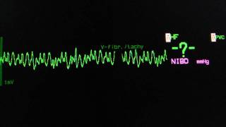 coarse ventricular fibrillation on an ECG heart monitor [upl. by Vasya819]