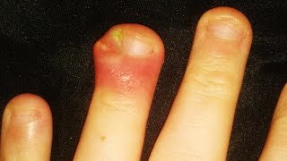 Cysts Warts Ingrown Nails Blisters amp Boils Mystery Diagnosis amp Medical Advice [upl. by Lussi]