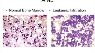 Molecular Underpinnings of Myeloid Malignancies 2018 [upl. by Venetia]