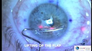 Femto Lasik by Dr Alex Lange [upl. by Enrika]