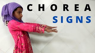 Understanding Chorea Common Signs in Children Chorea Signs [upl. by Conti674]