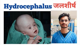 What is Hydrocephalus amp treatment hydrocephalus nursing mbbs medical norcet bscnursing gnm [upl. by Pope]