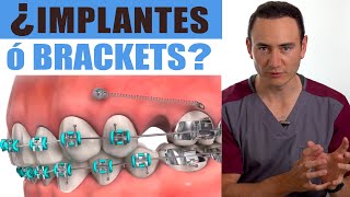 IMPLANTES o BRACKETS ¿Cuál va primero  ¡EL ORDEN SÍ IMPORTA  Ortodoncia vs Implantes [upl. by Ylram111]