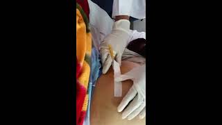 Tapping procedure for Ascites quot Paracentesis quot 1 [upl. by Lian]