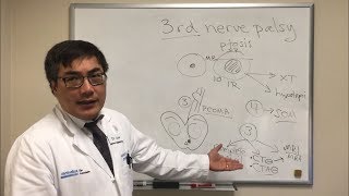 Cranial Nerve 3 CN III Palsy [upl. by Reis]