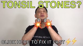 How to naturally get rid of tonsil stones [upl. by Anyal444]