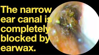 The narrow ear canal is completely blocked by earwaxear wax removal  ear cleaning  ASMR [upl. by Asli]