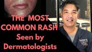 How to treat Perioral Dermatitis Dermatologist Explains [upl. by Nessy]