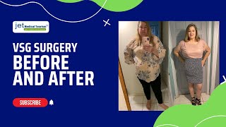 Gastric Sleeve Before and After Transformation  2022 [upl. by Marron]