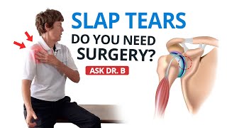 Shoulder Labral Tear  SLAP Lesion Do You Need Surgery Ask Dr B [upl. by Naujud]