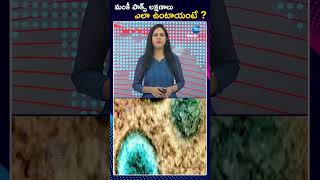 Symptoms of Monkey Pox Virus  మంకీ పాక్స్ లక్షణాలు ఎలా ఉంటాయంటే  ZEE Telugu News [upl. by Eiderf]