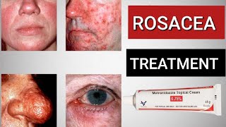 HOW TO TREAT ROSACEA  FULL SKINCARE SOLUTIONS [upl. by Ahsienad59]