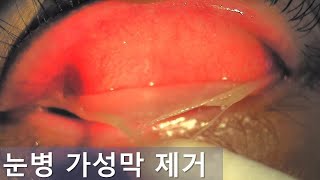 눈병 가성막 제거 Pseudomembrane peeling [upl. by Ahsiekahs685]