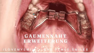 Gaumennahterweiterung was ist das [upl. by Siuqramed518]