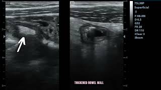 Ultrasound showing Enterocolitis [upl. by Garner]