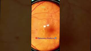 Diabetic retinopathy  Dot Hemorrhages  Hard exudates  Fundus  Short Video 175 [upl. by Etsirhc]