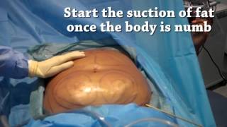 How is liposuction performed  Centre for Surgery [upl. by Akela]