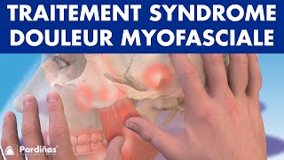 TRAITEMENT du Syndrome de DOULEUR MYOFASCIALE avec physiothérapie © [upl. by Mariken]