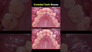 Complex braces for crowded teeth braces orthodontist dentist [upl. by Grey926]