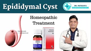 Epididymal Cyst Homeopathic Treatment amp Medicines  Dr Sunil Patidar [upl. by Blockus441]