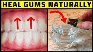 Cure Periodontal Disease At Home  Heal Gums Naturally [upl. by Feilak]