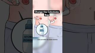 Colostomy care and change colostomy bag procedure steps  nursingofficer norcet aiims nursing [upl. by Minsat]