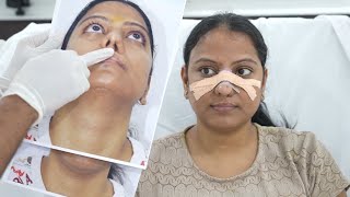 Remarkable Rhinoplasty Results Day 12 PostSurgery [upl. by Benedicta139]