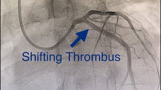 Thrombus Shifts to LCX Acute Anterior MI Cardiogenic Shock Ostial LAD Occlusion How To Treat [upl. by Aneba]