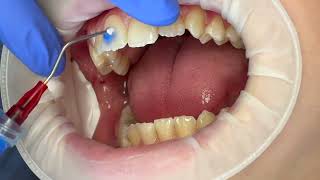 Hughes Orthodontics Custom Braces Process [upl. by Llacam]