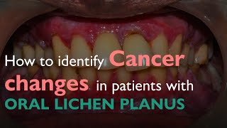 How to identify Cancer changes in patients with ORAL LICHEN PLANUS [upl. by Parrie]