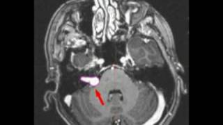 Dr Redleaf Chicago  Acoustic Neuroma [upl. by Atsejam271]