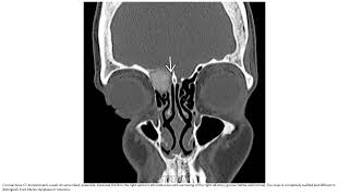 Sinonasal Ossifying Fibroma Imaging [upl. by Uriisa]