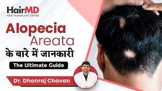 Ultimate Alopecia Areata Guide  Alopecia Areata के बारे में जानकारी  HairMD Pune [upl. by Aisined]