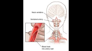 Applied or clinical anatomy of vertebral artery  Occlusion to branches of vertebral artery [upl. by Carleen500]