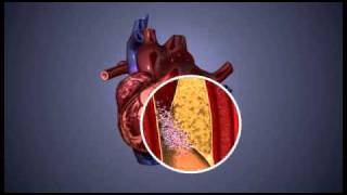 Atherosclerosis  3D Animation  ABP © [upl. by Ewell]