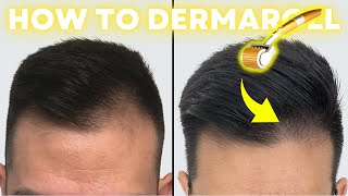 How to Derma Roll for Quickest Hair Results StepbyStep Guide [upl. by Barncard]