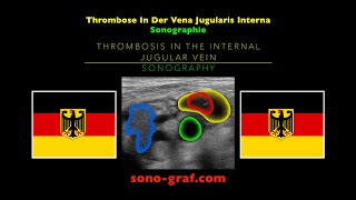 Sonographie  Thrombose In Der Vena Jugularis Interna [upl. by Yvan910]