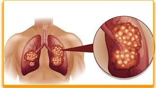 Wczesne objawy raka płuc – 9 najczęstszych objawów [upl. by Einohtna]