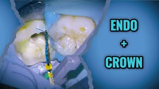 84 Massive cavity leads to root canal and crown live procedure [upl. by Oigaib]