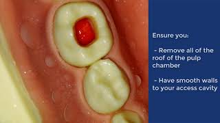 Pulpotomy of Deciduous Molar  QMUL [upl. by Thar]