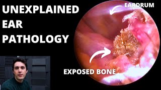 Benign Necrotising Otitis Externa 3 cases [upl. by Watanabe]