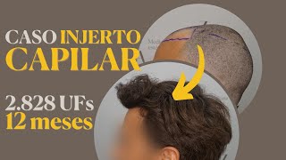 INJERTO CAPILAR ▶ RESULTADO en 12 MESES ✅ EXPLICADO por TRICÓLOGA [upl. by Trina]