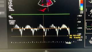 Annulus paradoxus motion in constrictive pericarditis [upl. by Ocsinarf]