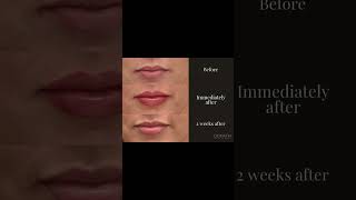 Lip filler in stages lipaugmentation drdonath [upl. by Nyvets]