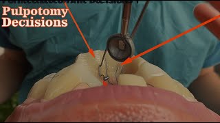 Indications for Coronal vs Partial Pulpotomy Irreversible Pulpitis [upl. by Eyaj]