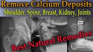 Remove Painful Calcium Deposits From Your Body 3 Best Home Remedies  Dr Mandell [upl. by Donell770]