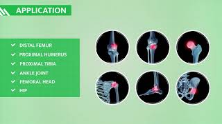 ORTHOPLASTY™  BPB MEDICA™  Subchondral Bone Marrow Lesions BMLs treatment kit [upl. by Erialc]