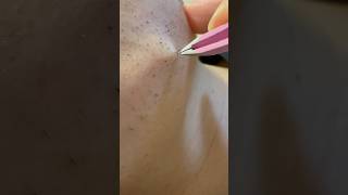 Just Tweezing Beard Hairs hairremoval satisfying tweezers [upl. by Iliram969]