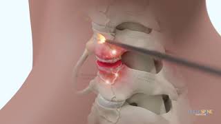 Cervical Deuk Plasma Rhizotomy DPR C3C4 C4C5 for Neck Pain from Facet Joint Arthropathy [upl. by Morgana]