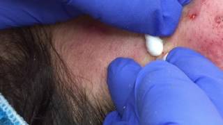 Blackhead Extractions on Leslie [upl. by Nodlehs619]